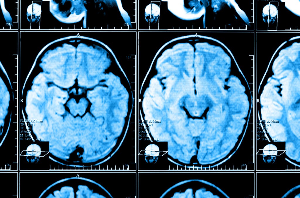 Brain scans